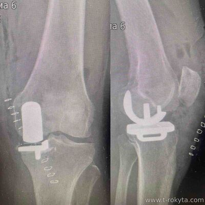Часткова заміна колінного суглобу Часткова заміна колінного суглобу